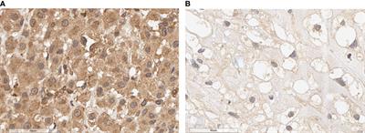 PALB2 as a factor to predict the prognosis of patients with skull base chordoma